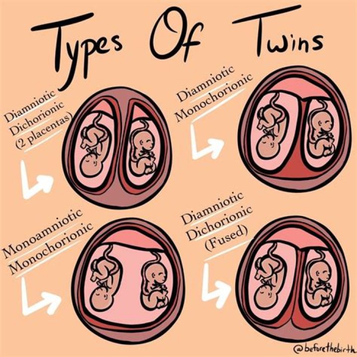 Are dichorionic diamniotic twins identical?