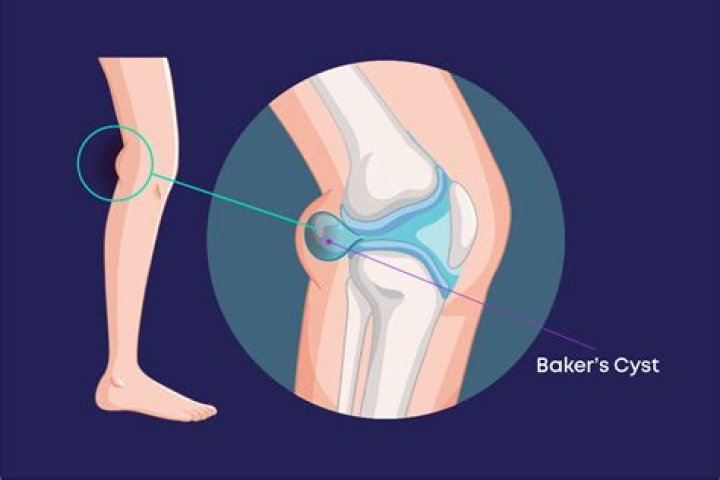 Are popliteal cyst dangerous?