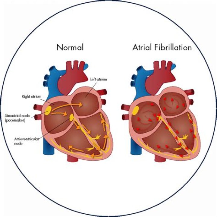 Atrial fibrillation at 40?