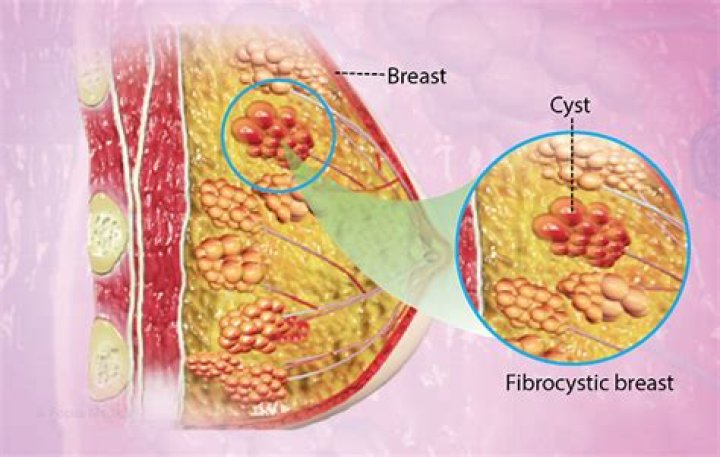 Can fibrocystic breasts hurt all the time?