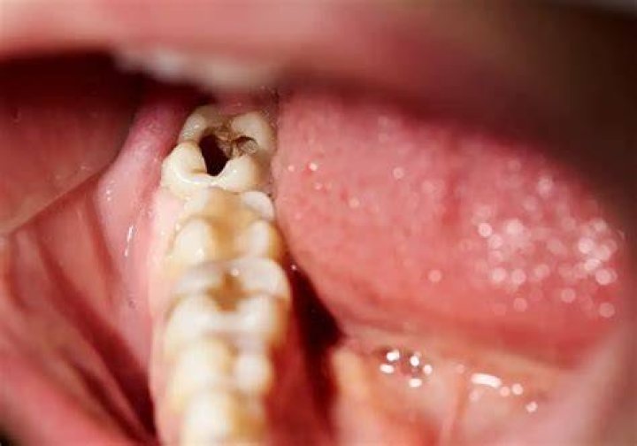 Can holes in teeth heal?