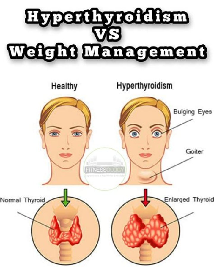 Can hyperthyroidism cause weight gain?