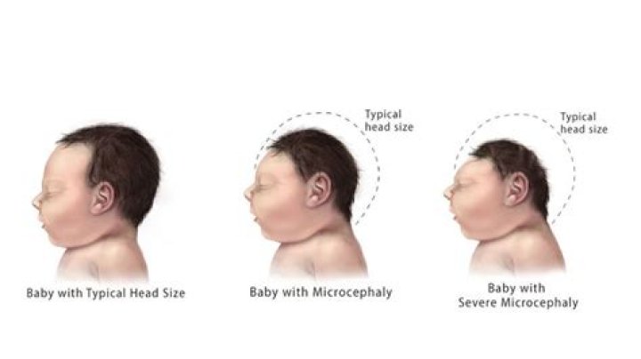 Can microcephaly be prevented?