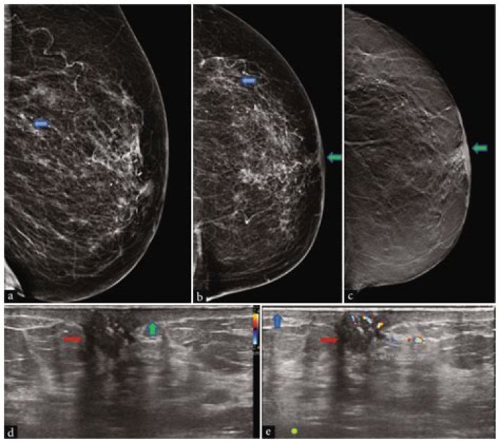 Can paget's disease be seen on a mammogram?