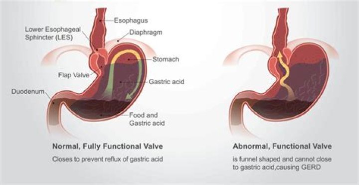 Can reflux affect breathing?