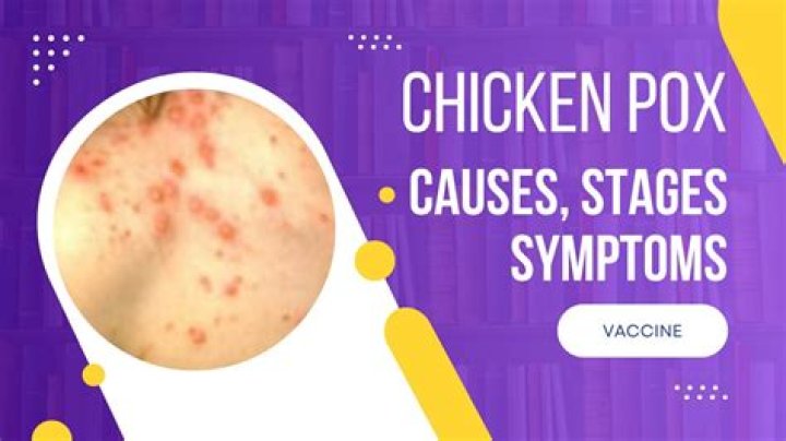 Did chickenpox get its name?