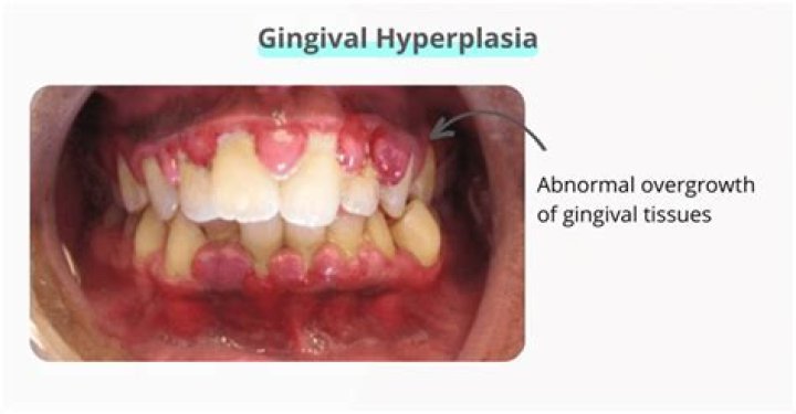 Do ace inhibitors cause gingival hyperplasia?