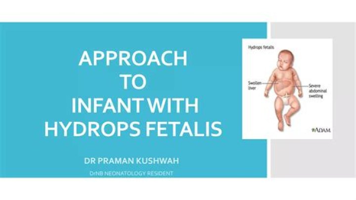 Do babies born with hydrops survive?