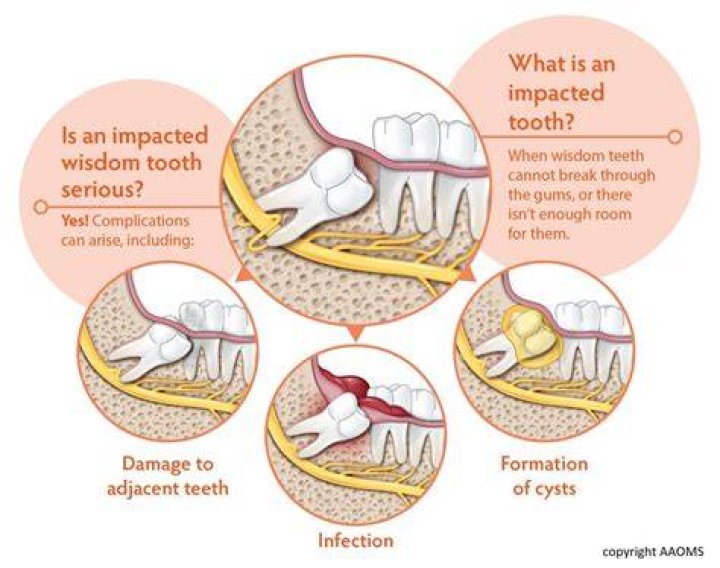 Do wisdom teeth hurt?