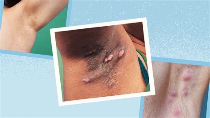 Does hidradenitis suppurativa get worse?