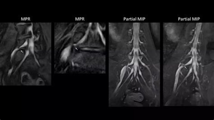 Does mri show nerves?
