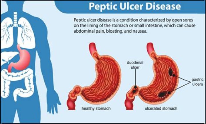 How do ulcers feel like?