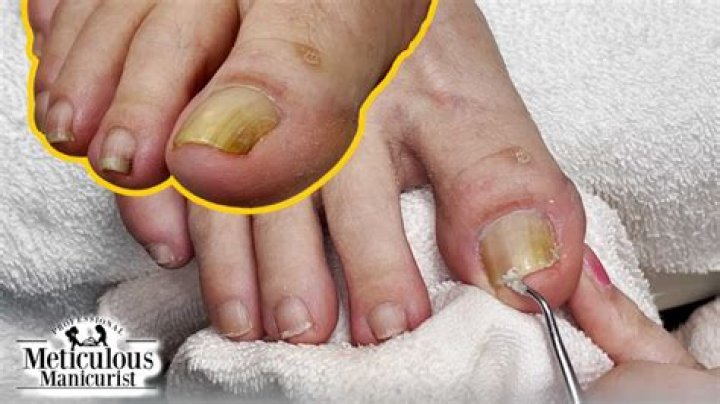 How to get rid of yellow stained toenails?