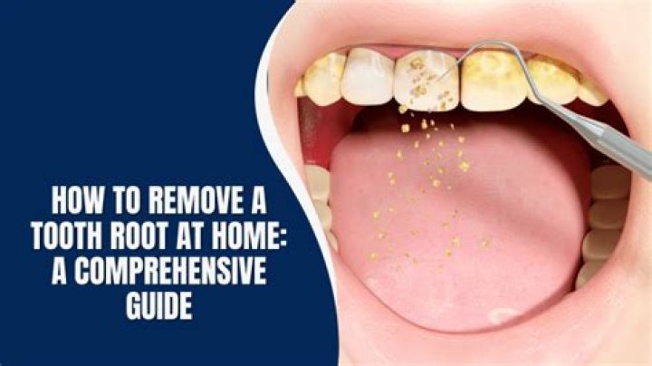 How to remove a tooth root at home?