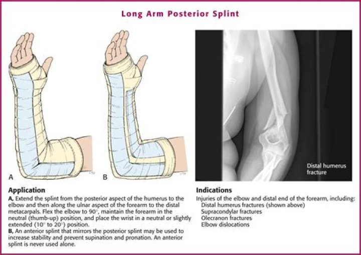 Is a coaptation splint a long arm splint?