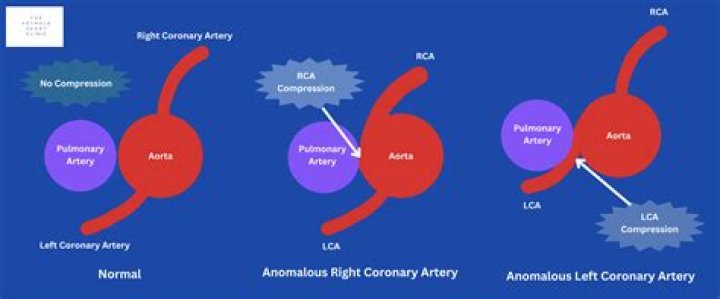 Is anomalous coronary artery dangerous?