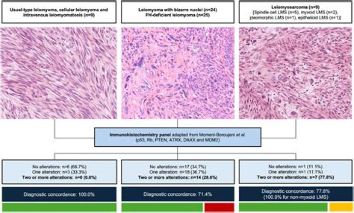 Is benign metastasizing leiomyoma cancer?