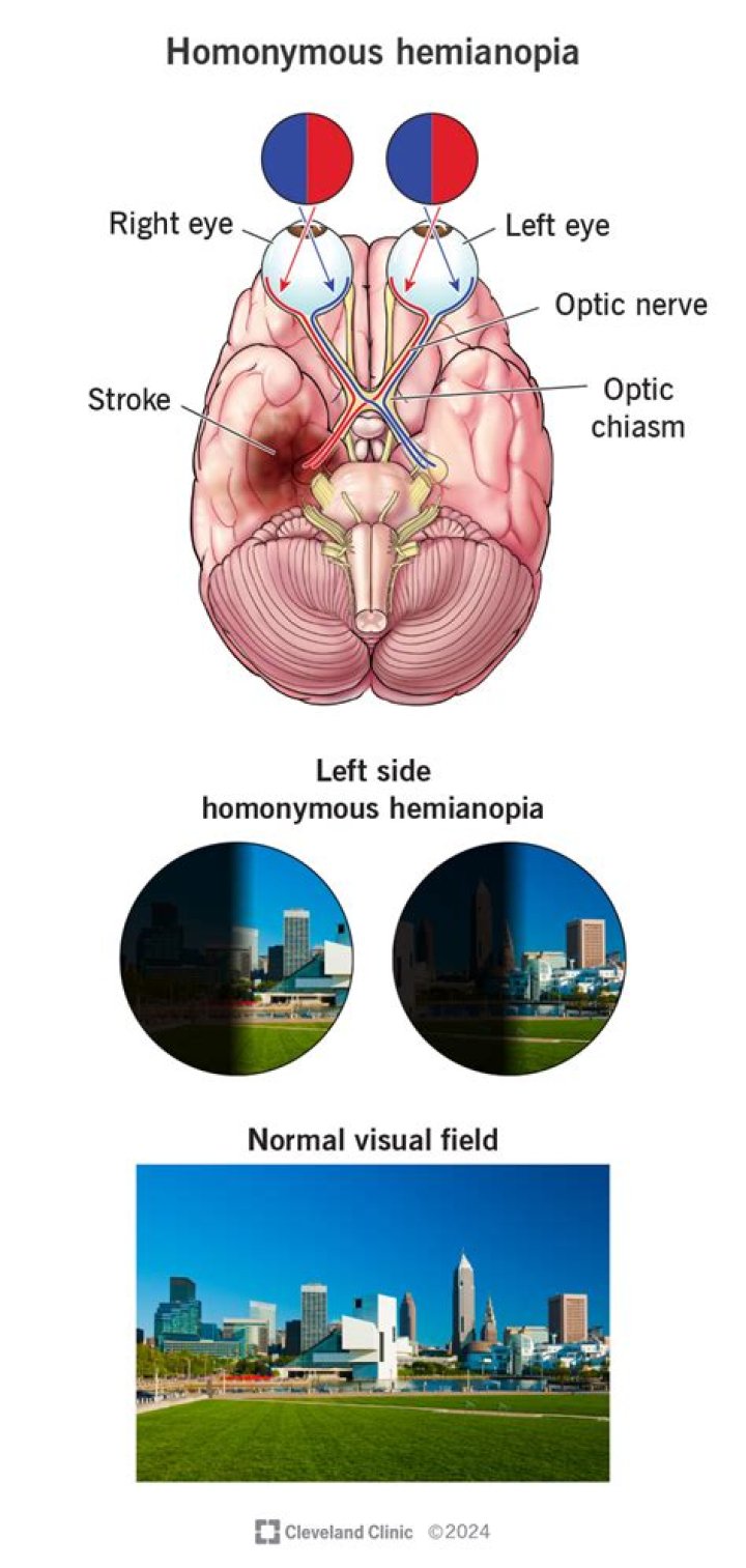 Is homonymous hemianopia permanent?