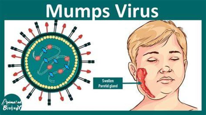 Is mumps singular or plural?