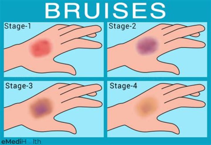 Should bruising get worse?