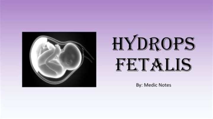 Was ist hydrops fetalis?