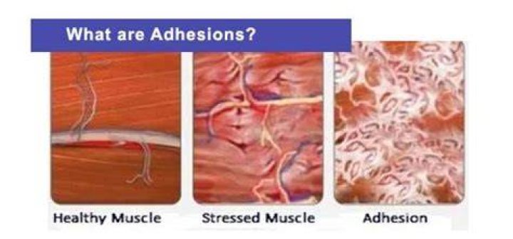 What adhesions feel like?