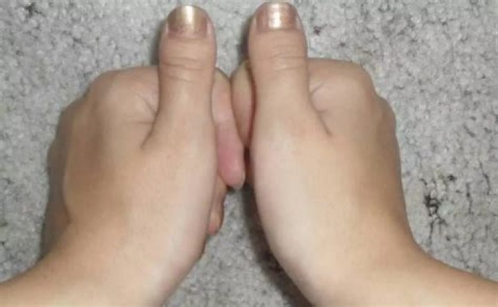 What causes brachydactyly type d?