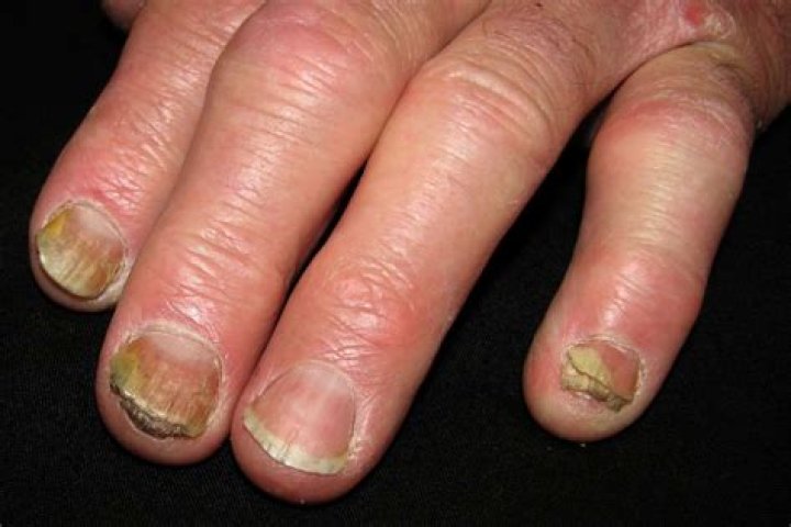What causes breakage of nails?