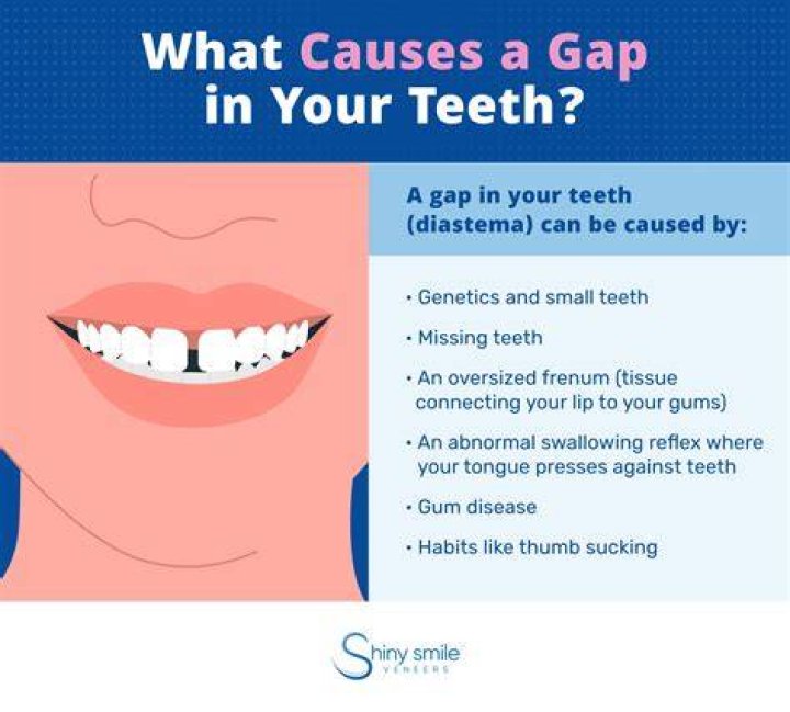 What does gap in your teeth mean?