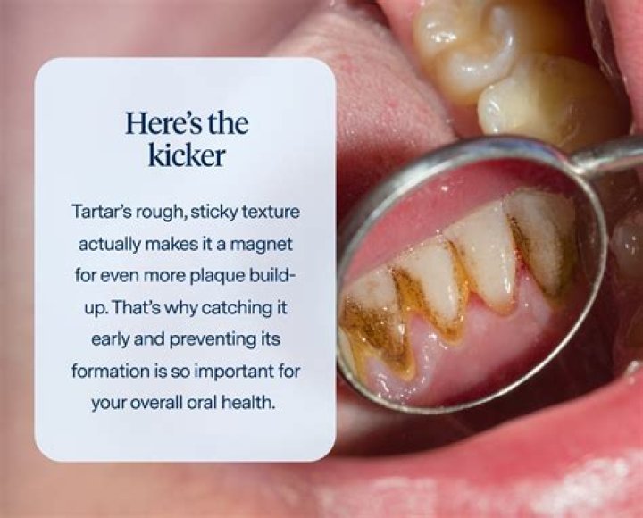 What happens if you have tartar on your teeth?