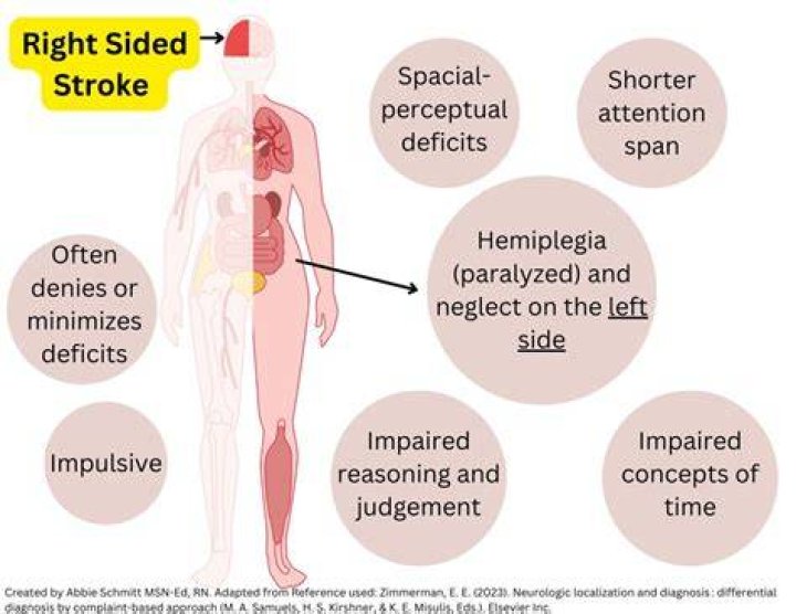 What is a right sided stroke?