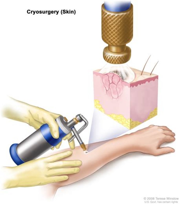 What is cryotherapy used for?