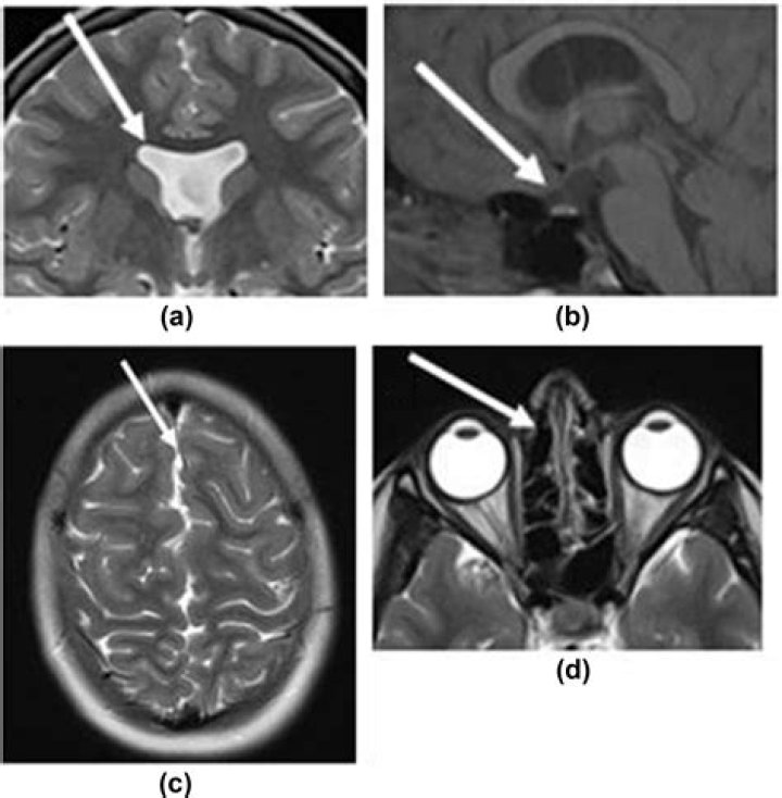 What is septo optic dysplasia of brain?