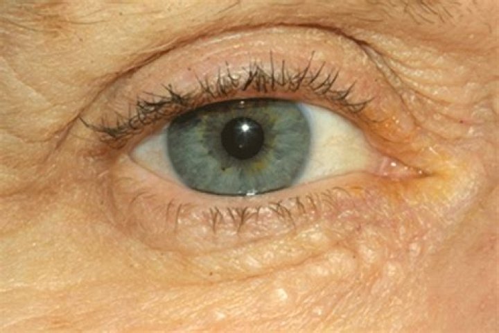 What is syringoma under eye?