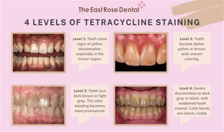 What is tetracycline teeth?