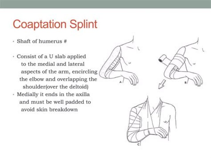 What is the cpt code for coaptation splint?