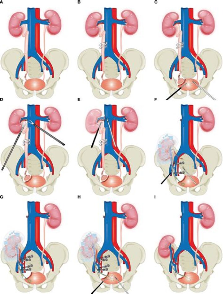 What is the medical definition for autotransplantation?