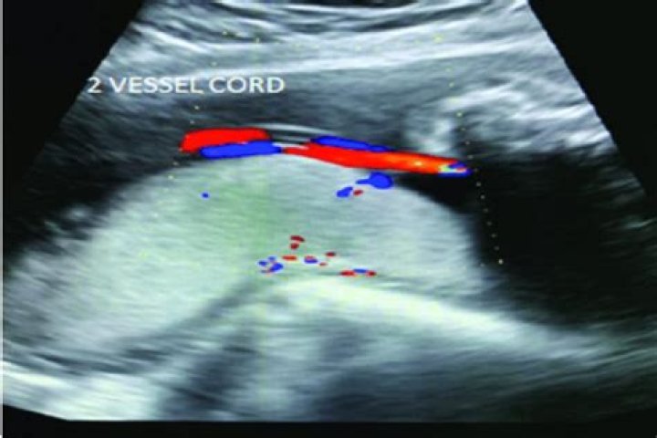 Whats a two vessel cord?