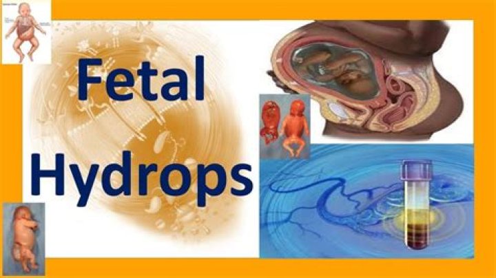 When does hydrops occur?