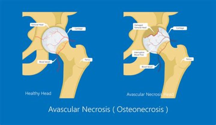 When was avascular necrosis discovered?