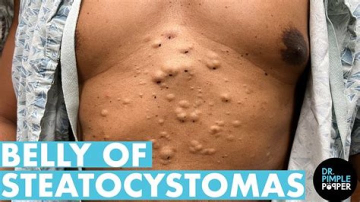 Where do steatomas usually appear?
