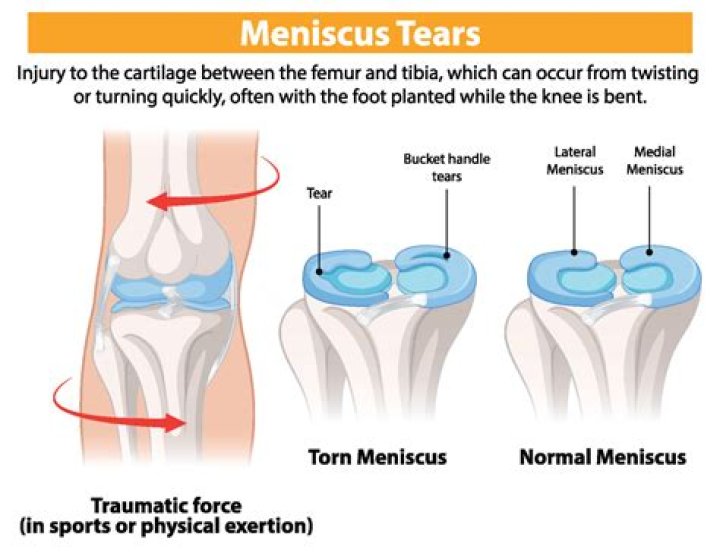 Which meniscus is more likely to tear?