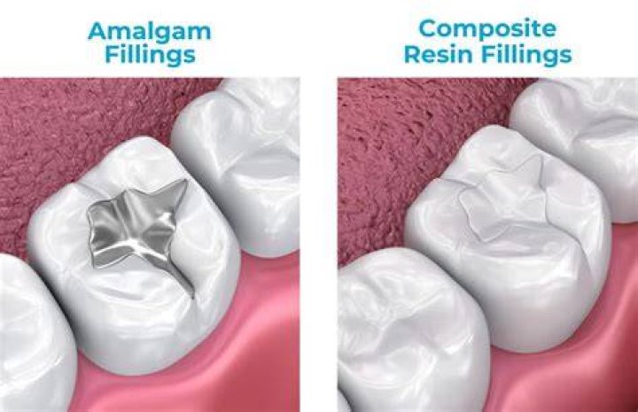 Who is composite filling?