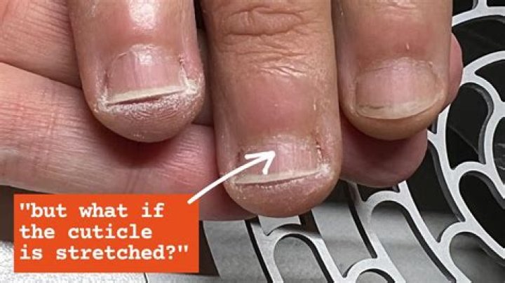 Why are my cuticles overgrown?