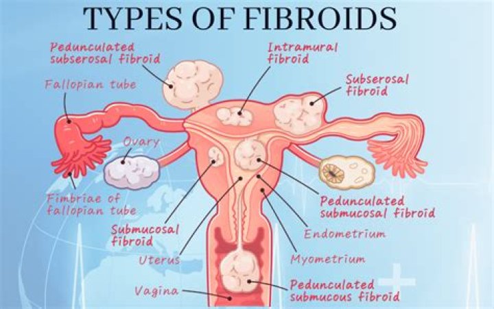 Why do fibroids cause bleeding?