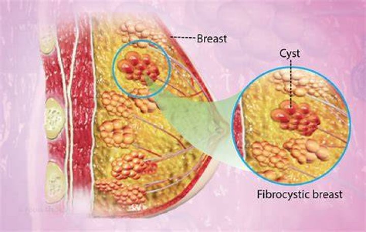 Why does my fibrocystic breast hurt?