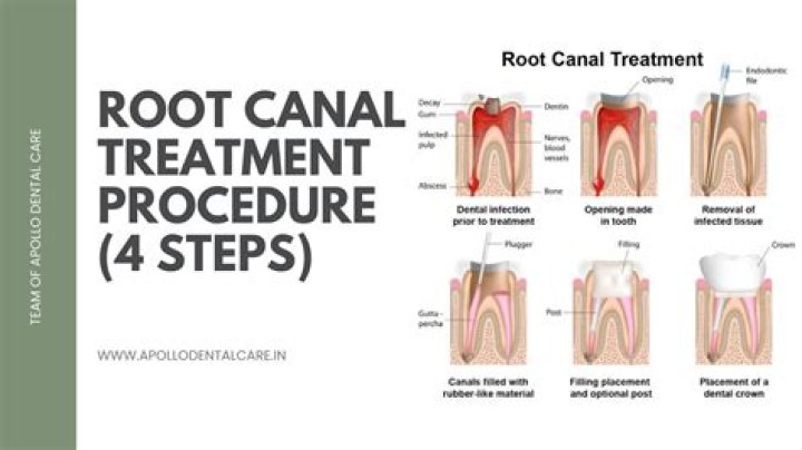 Why does root canaled tooth hurt?