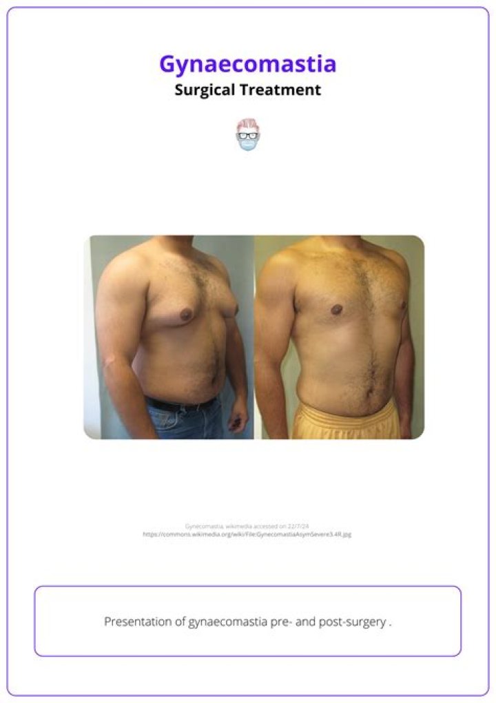 Why gynaecomastia in leprosy?