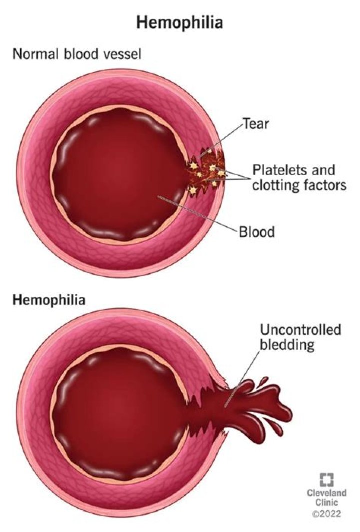 Why is internal bleeding fatal to a hemophiliac individual?