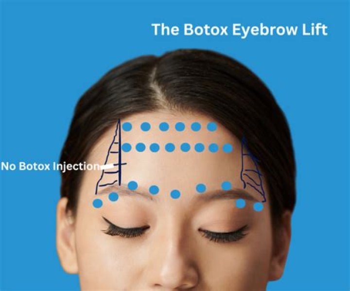 Will botox make my forehead smooth?